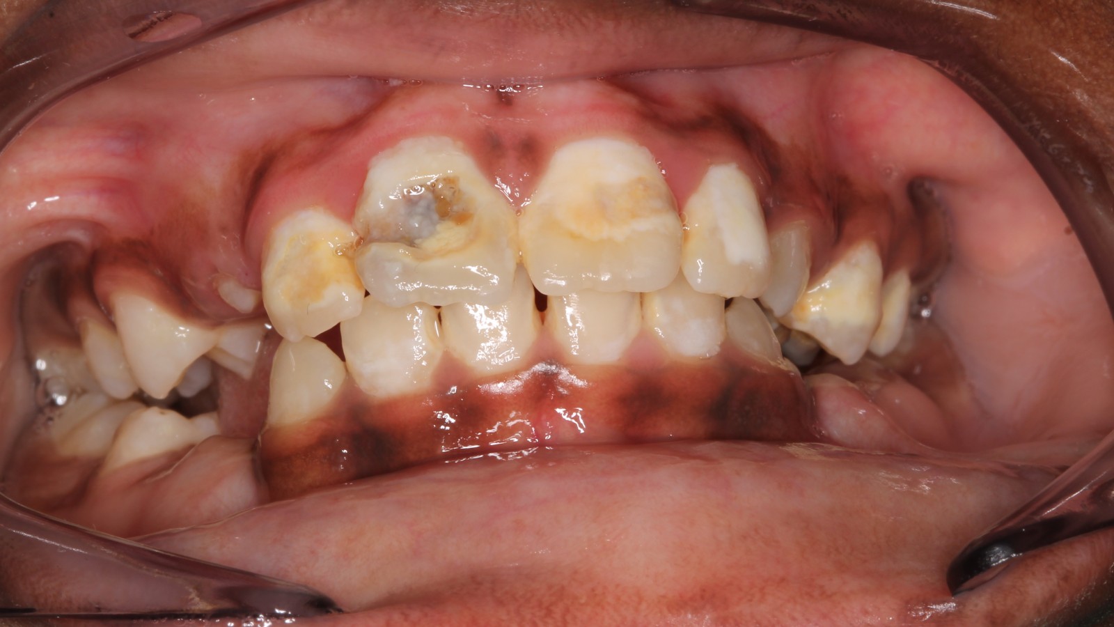 Zorgen om kindergebitten: 'Gaan soms nooit naar tandarts'