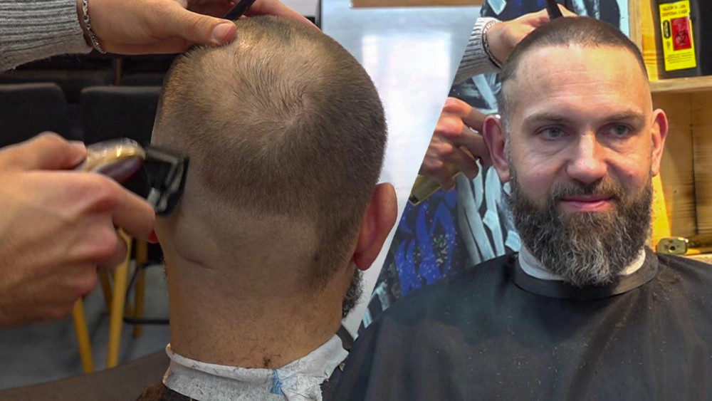 Haartransplantaties steeds populairder, maar: "Kaalheid moet je omarmen